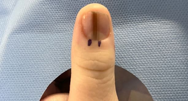 손톱에 생긴 갈색 줄?… 절대 그냥 넘기지 마세요
