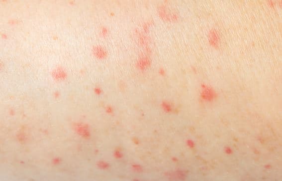 온주 홍역 감염 산모에게 태어난 '신생아 최초 사망'